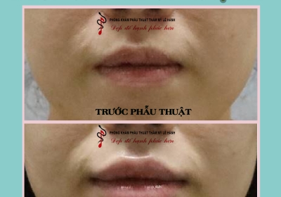 LÀM ĐẸP ĐÔI MÔI BẰNG PHƯƠNG PHÁP CẤY MỠ TỰ THÂN