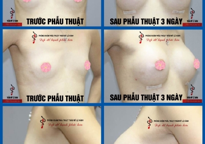 Đặt túi ngực và những điều bạn có thể chưa biết!