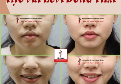 Tạo má lúm đồng tiền