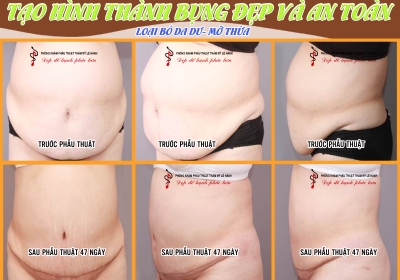Tạo hình thẩm mỹ bụng- bệnh nhân có bụng lớn độ 4