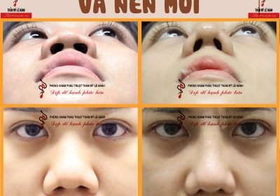 Tầm quan trọng của chỉnh hình cánh mũi và nền mũi
